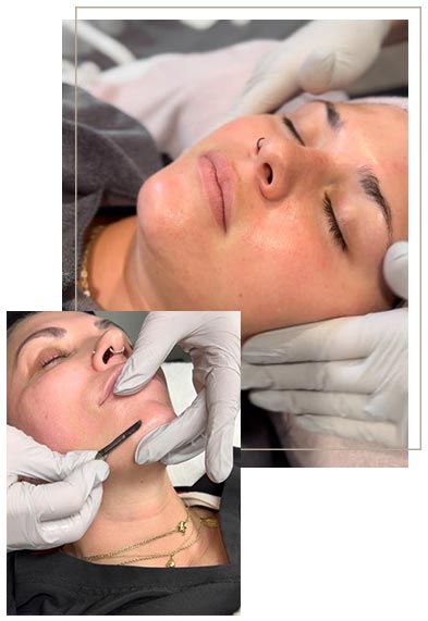 dermaplane treatment