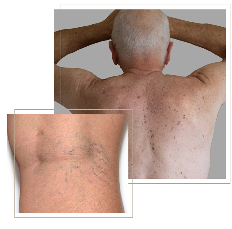 spider vein and sun spot removal