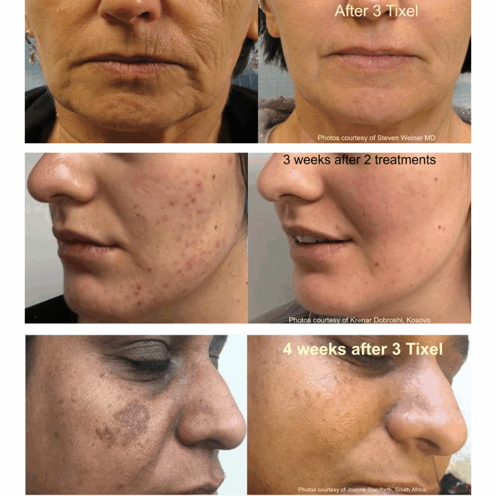 skin resurfacing