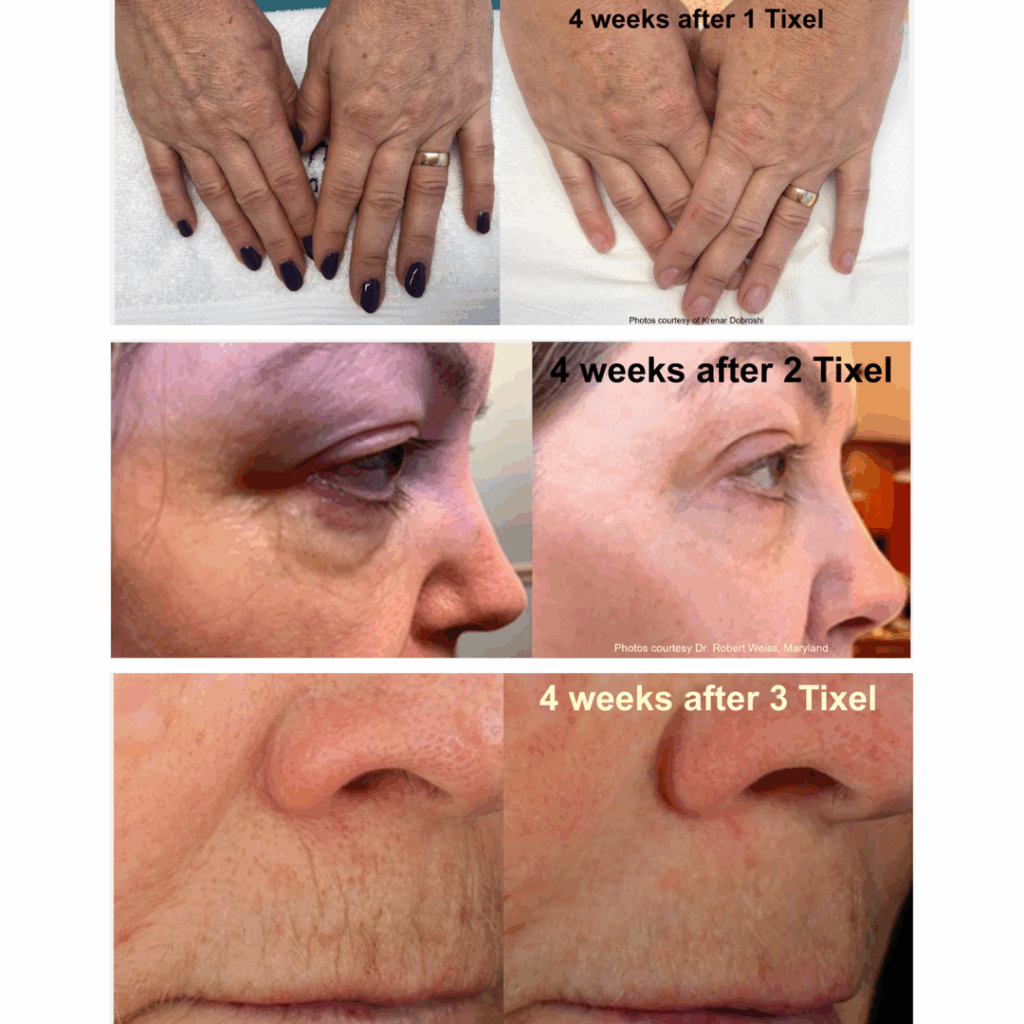 skin resurfacing treatment