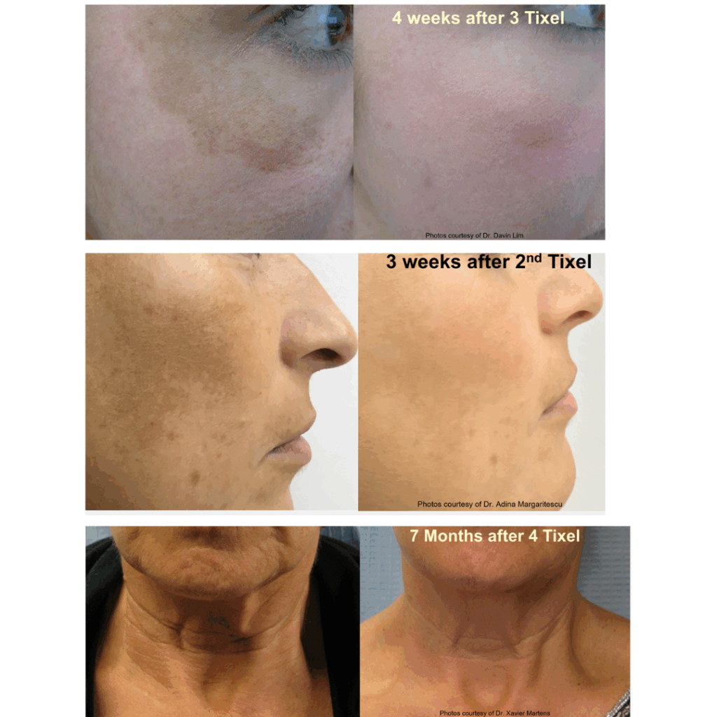 skin resurfacing treatment