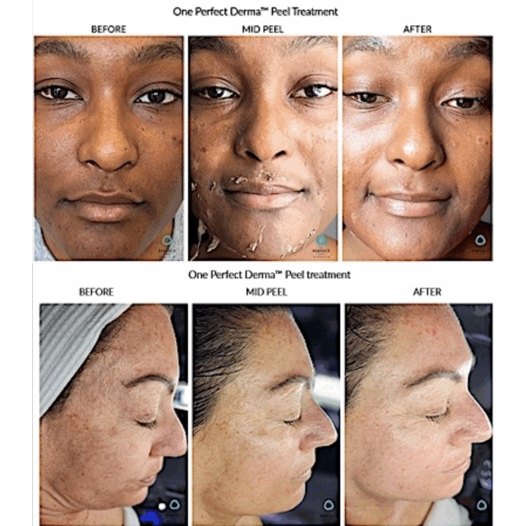 Perfect Derma Peel